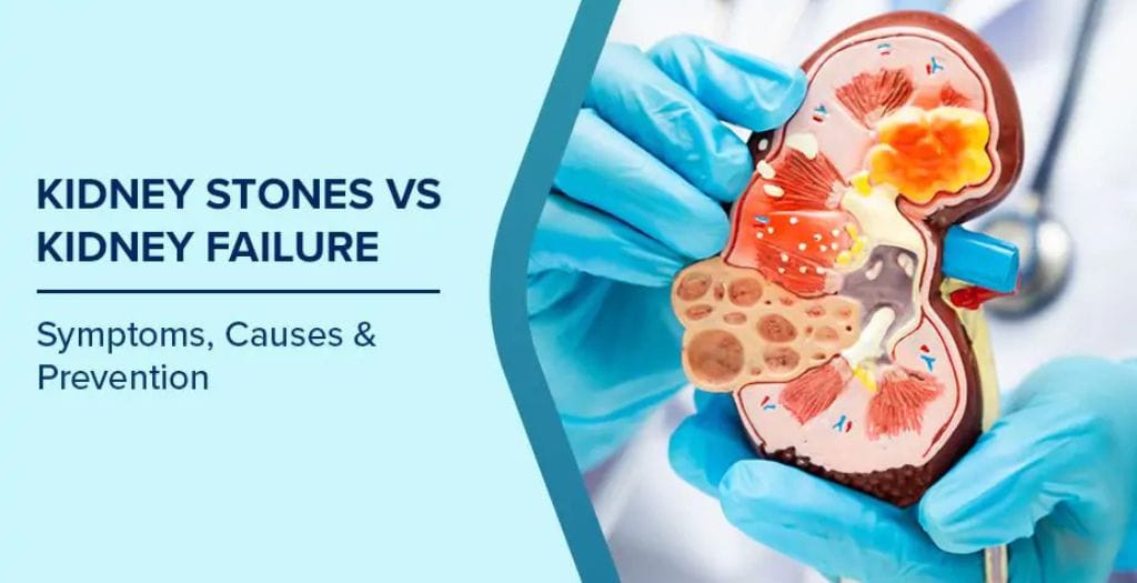 kidney-stones-blog