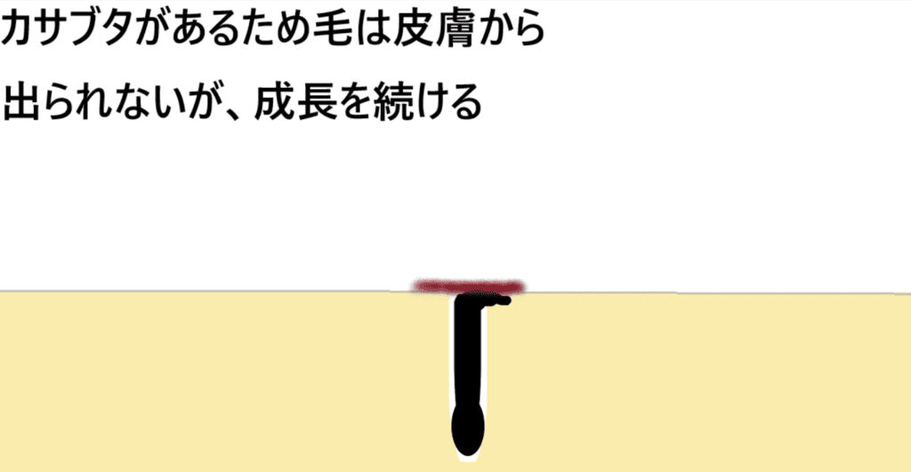 皮膚が再生する際に、毛穴と一緒に毛を埋めてしまう