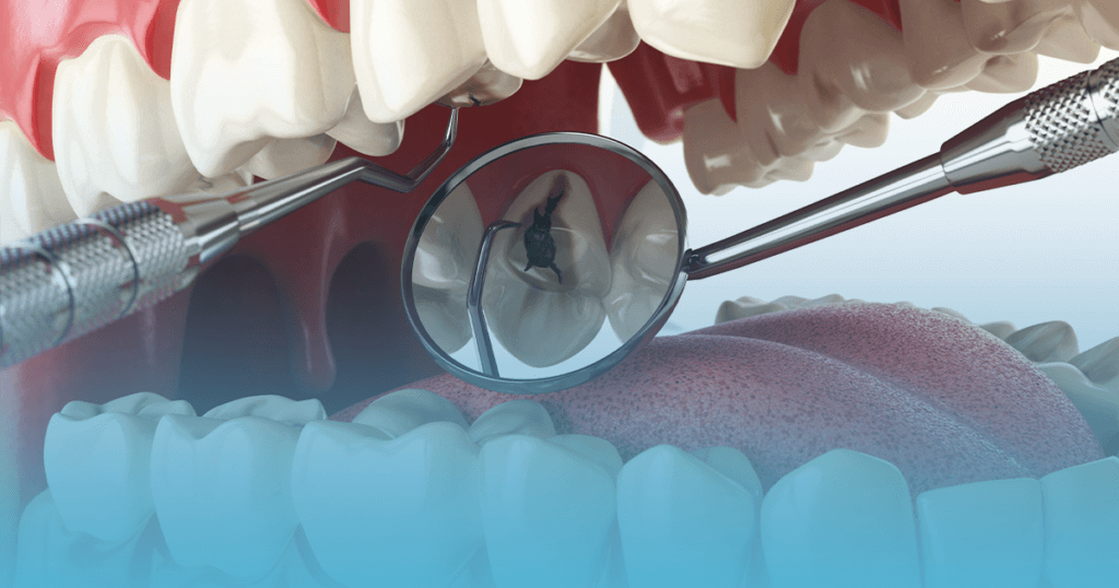 carii dentare