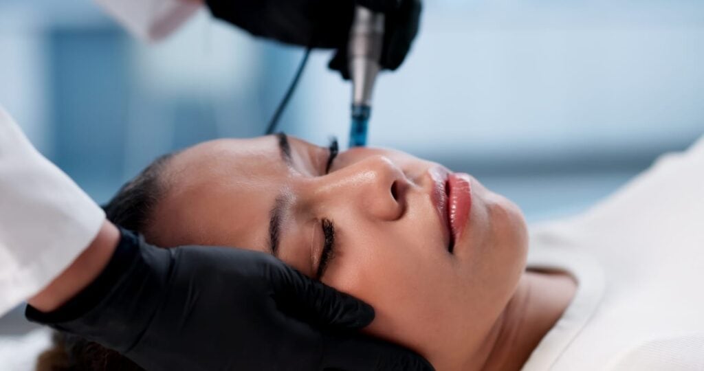 Solution to Get Rid of Fine Lines Around Your Eyes - Microneedling in Regina with Visage  