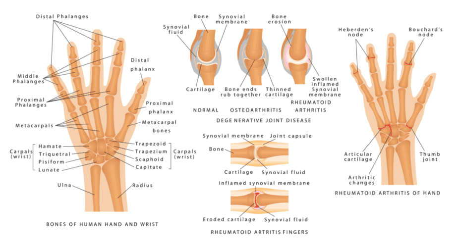 Arthritis Disease Progression - BOT Portal