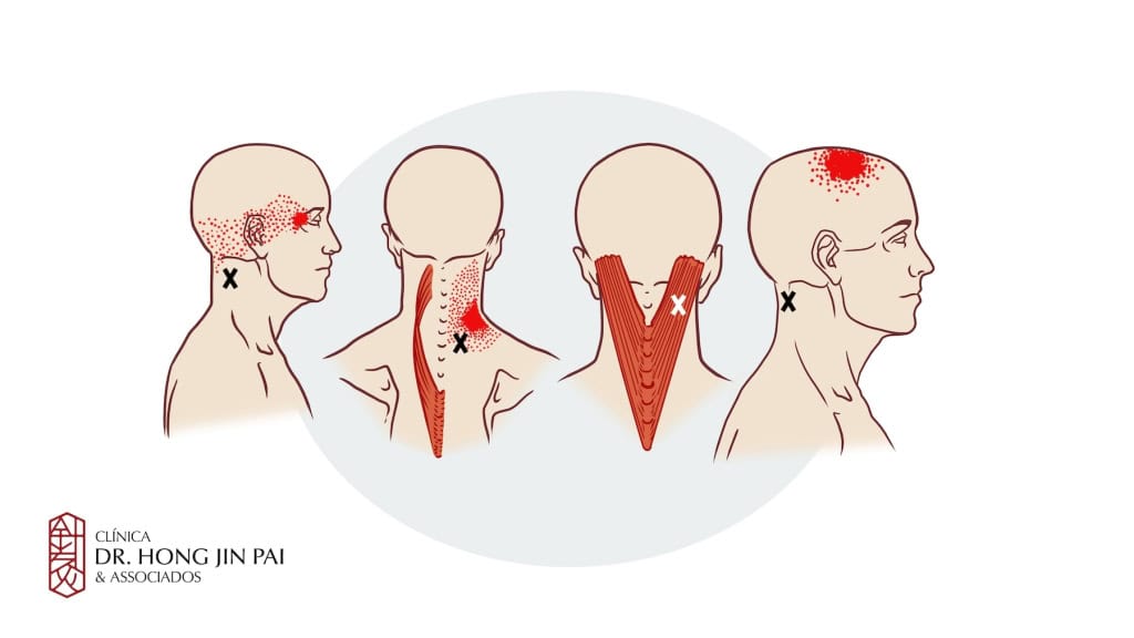 Entendendo a Dor que Ninguém Vê: Um Guia Sobre a Síndrome da Dor Miofascial 3 Sindrome Dolorosa Miofascial Cervical Dor no pescoco