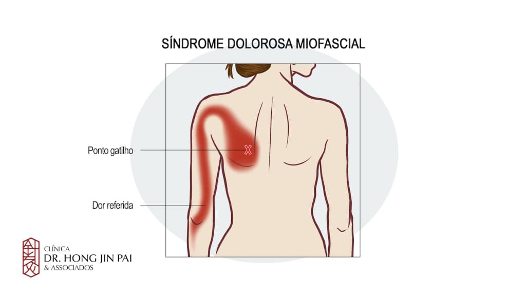 Entendendo a Dor que Ninguém Vê: Um Guia Sobre a Síndrome da Dor Miofascial 1 sindrome dolorosa miofsacial