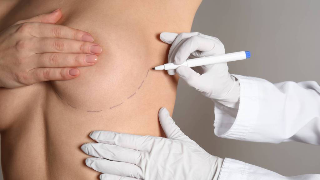 Aumento de pecho en Valencia - mamoplastia de aumento Clínica Fontana