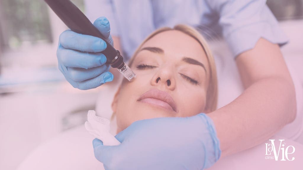 Microneedling Before and After results