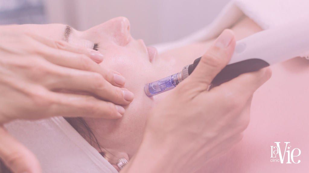 microneedling before and after for Glowing Skin