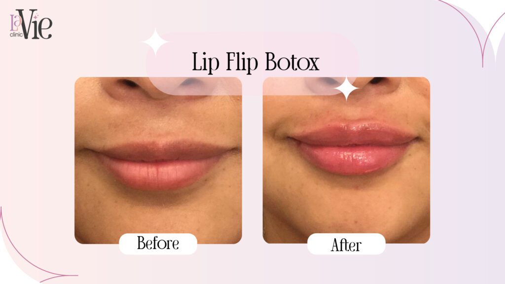 Botox Lip Flip before and after