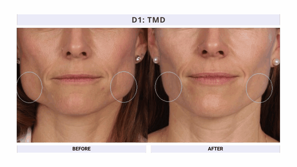 TMD Treatment using Botox