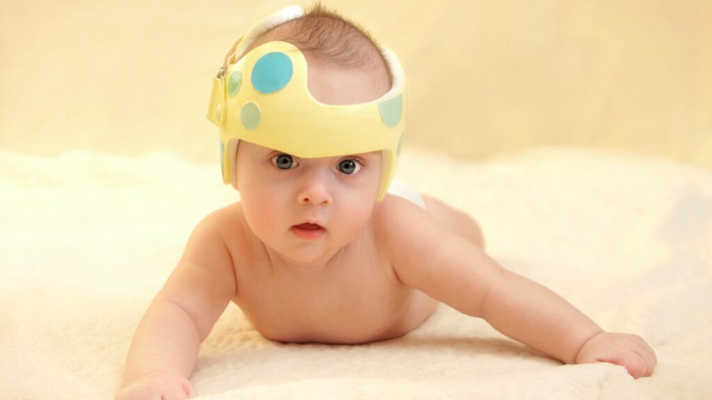 Bebé con plagiocefalia usando casco ortésico