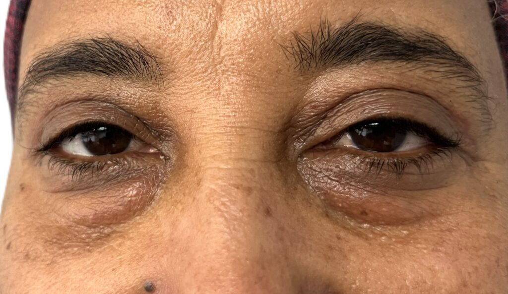Before blepharoplasty photo showing upper eyelid hooding and lower eyelid puffiness with under-eye bags