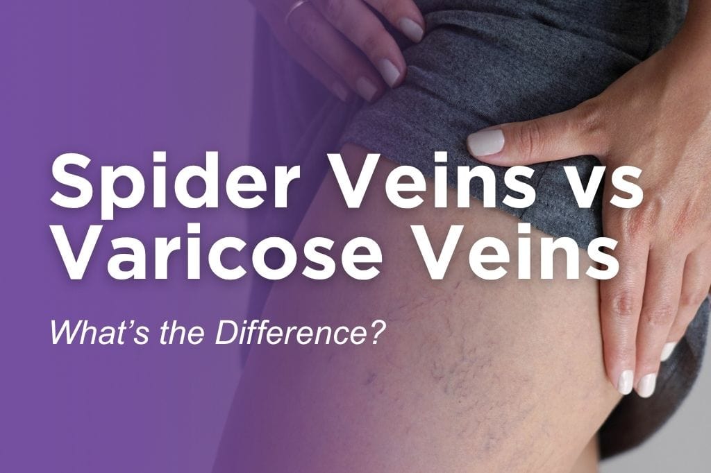 Close-up of a thigh showing difference between spider veins and varicose veins.