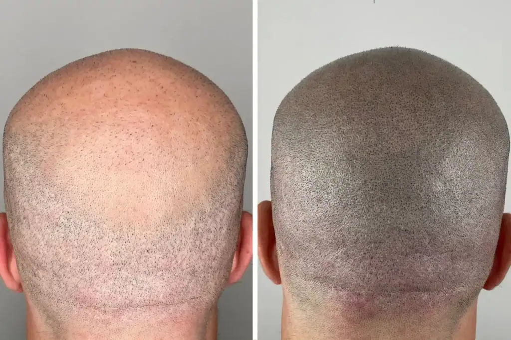 SMP before and after results for hair density