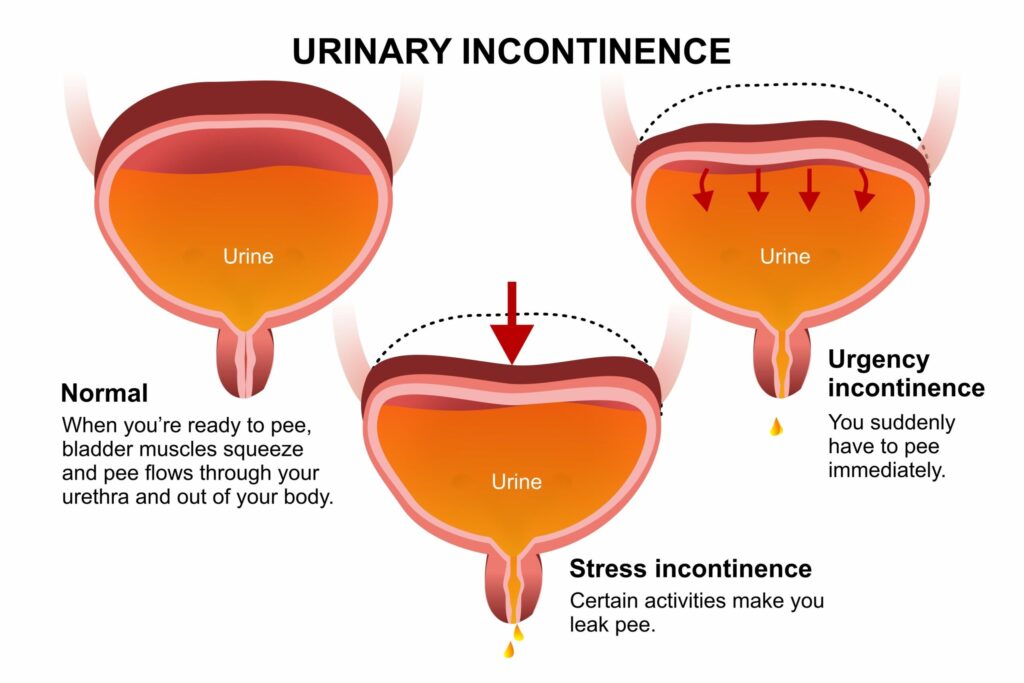 a diagram demonstrating the basics of stress and urge incontinence