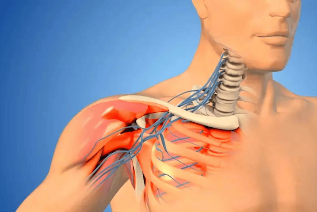 Can adults recover from brachial plexus palsy? Treatments that help Brachial Plexus Injury