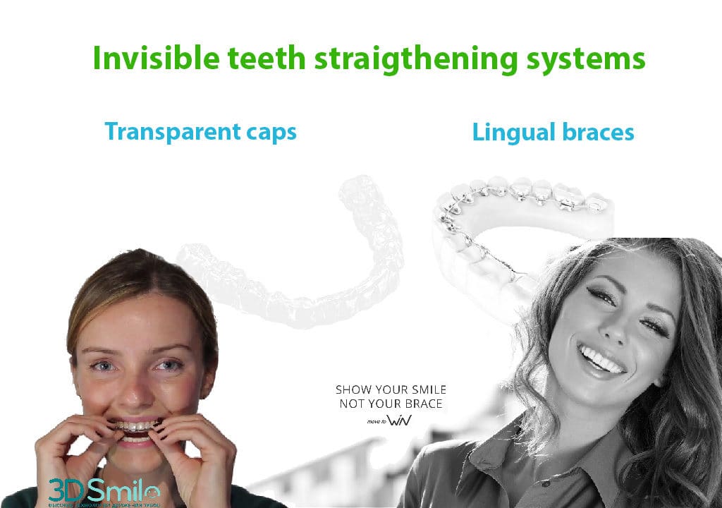Clear aligners and lingual braces