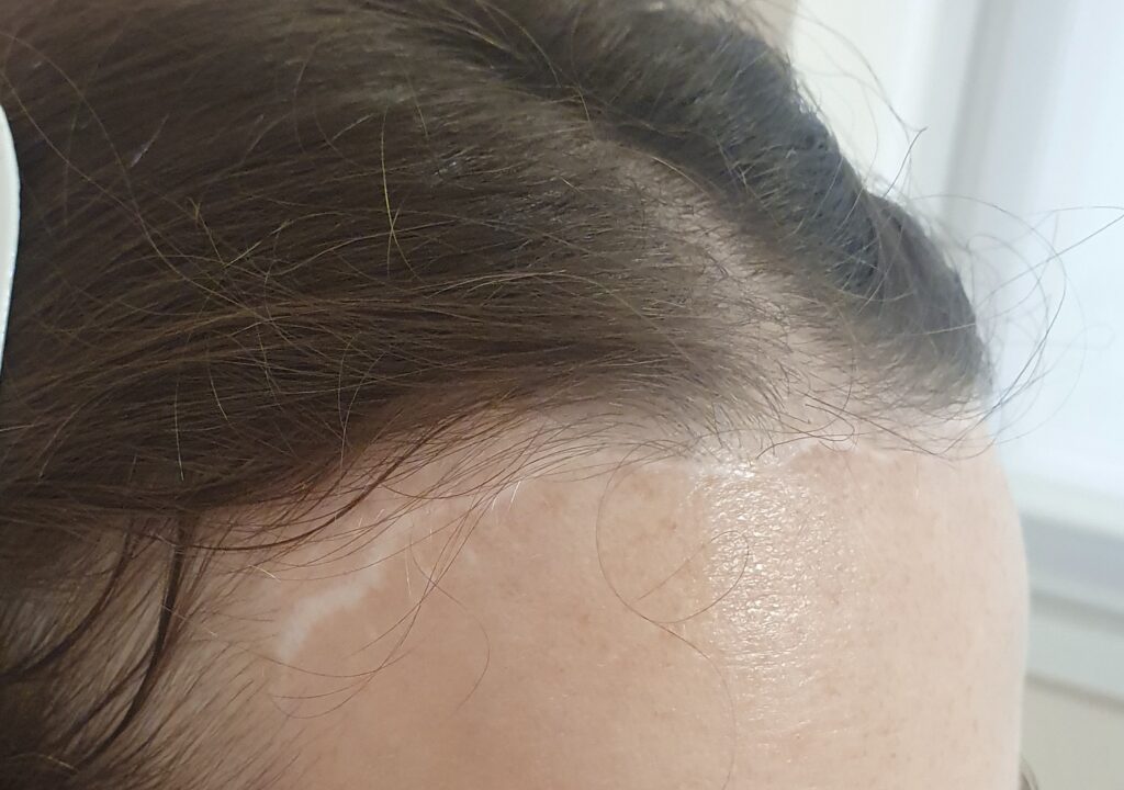 Cuidado de cicatrices postquirúrgicas