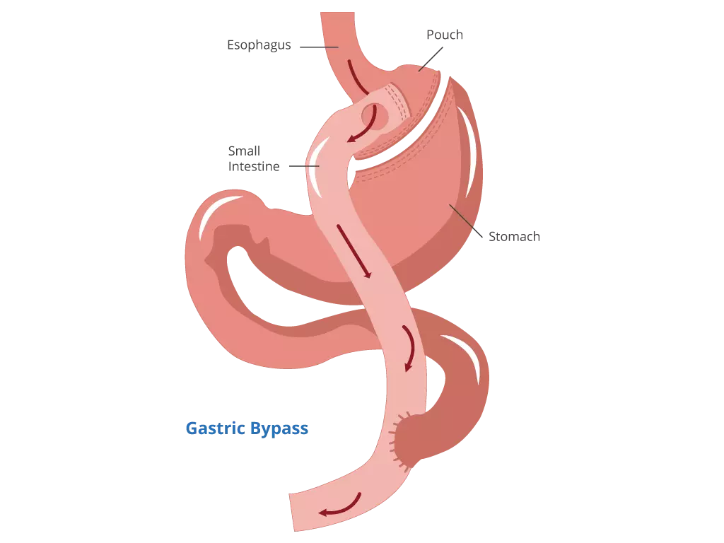 Gastric Bypass Surgery Gastric Bypass Surgery