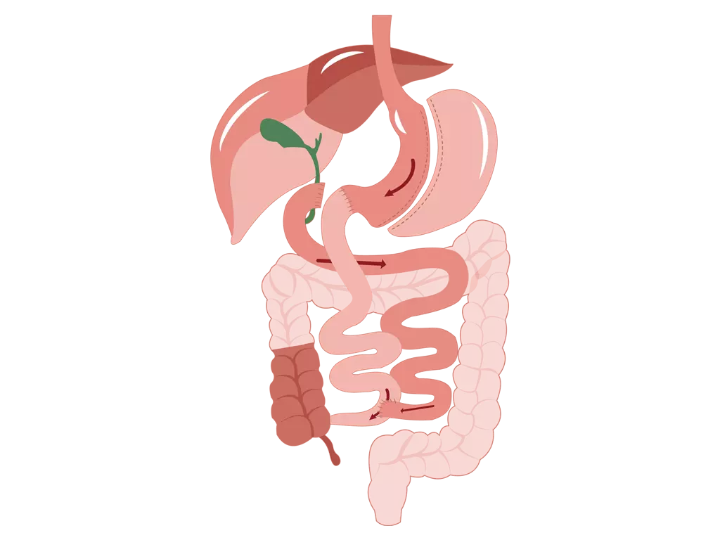 Duodenal Switch Duodenal Switch