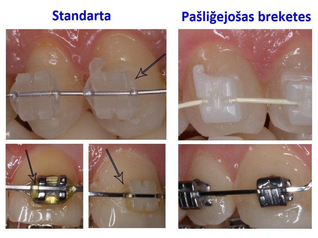 Pašliğejošas breketes