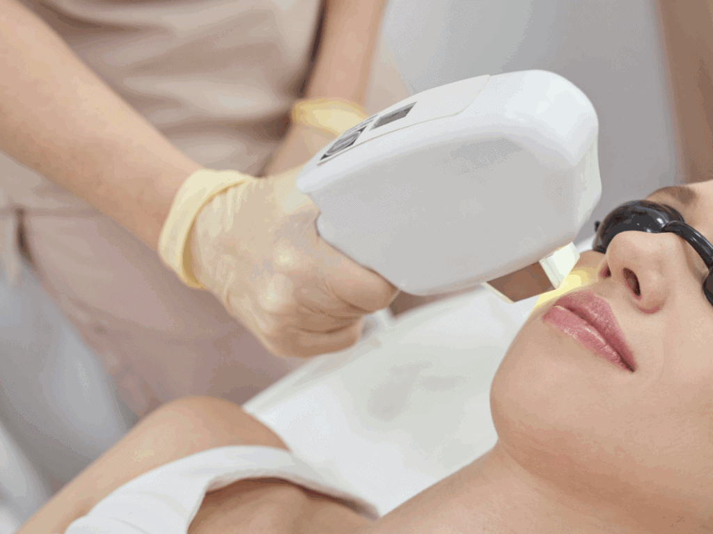 IPL laser ontharing
