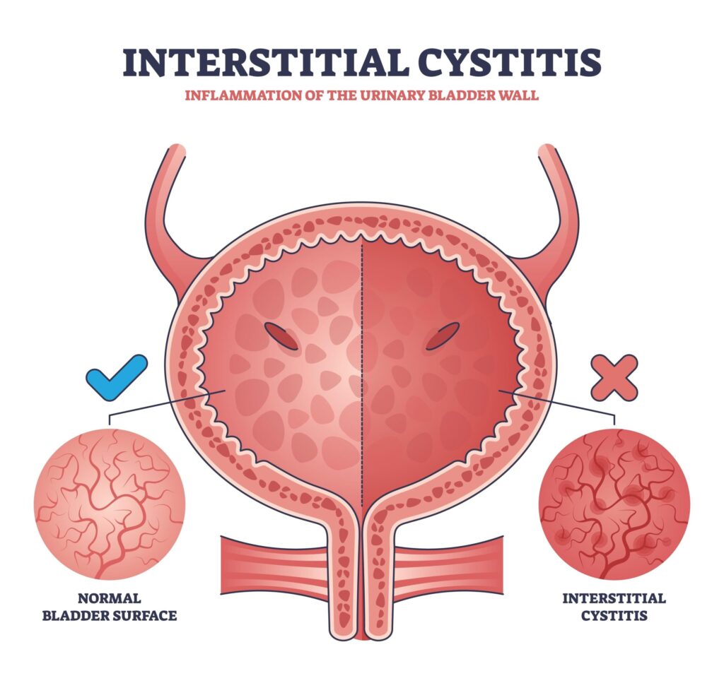 a diagram demonstrating the basics of interstitial cystitis