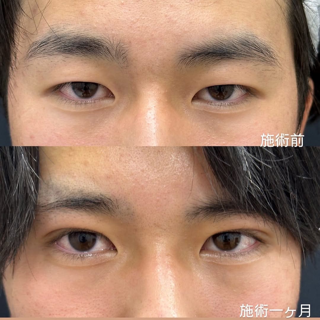 メンズ二重