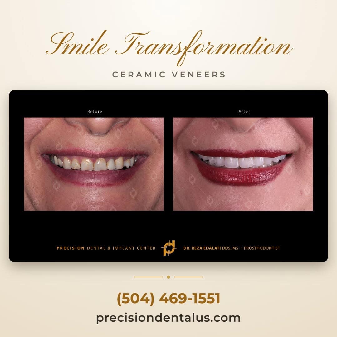 Smile transformation with ceramic veneers at Precision Dental & Implant Center in New Orleans, LA