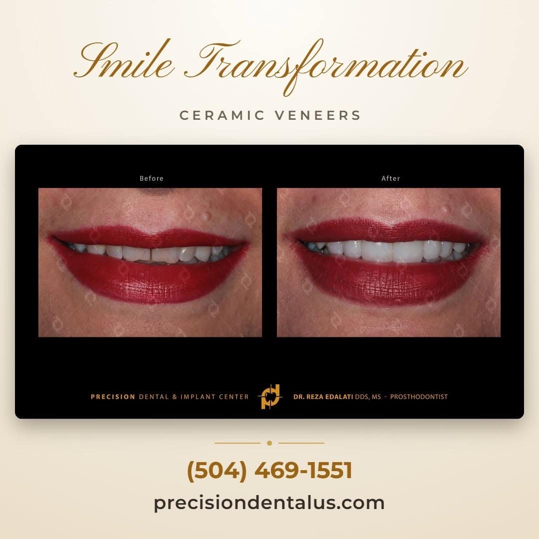 Ceramic veneers smile transformation by prosthodontist Dr. Reza Edalati in New Orleans, LA