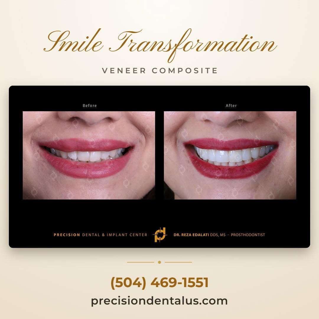 Smile transformation with Veneer Composite at Precision Dental & Implant Center in New Orleans, LA