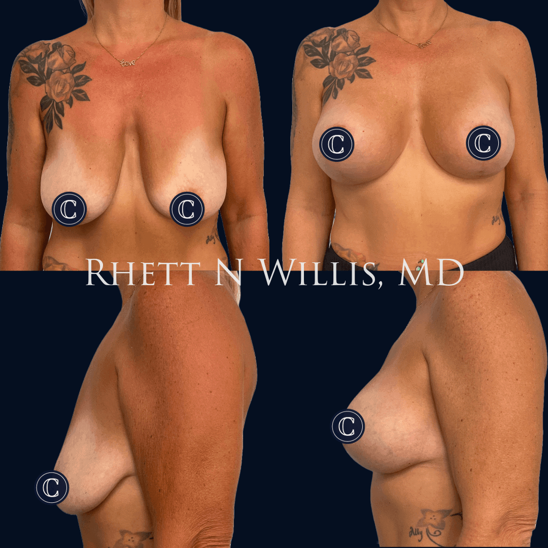 AJ Aug-Lift 345cc, 3mo-1