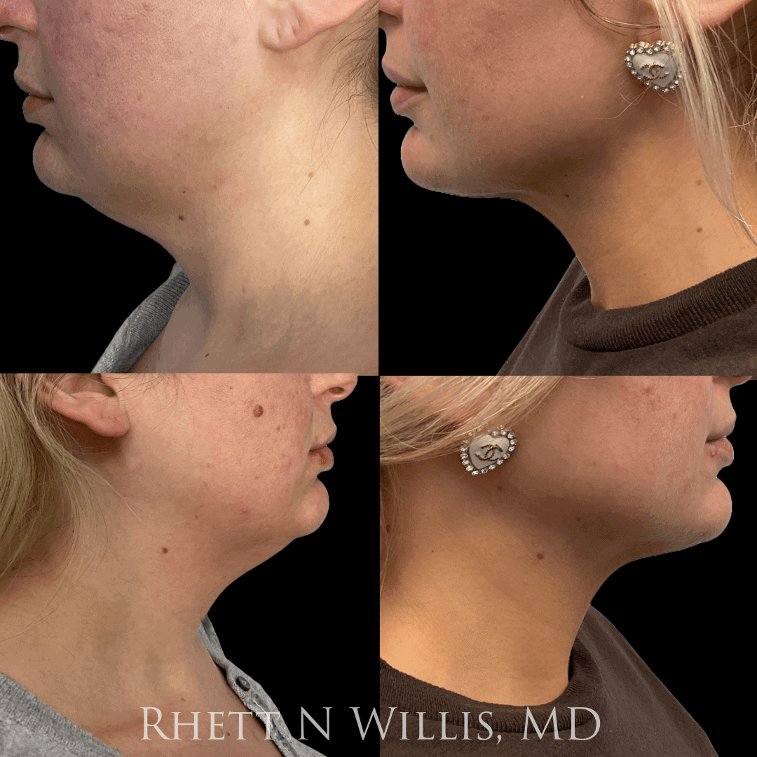 OP Neck Lipo and FT