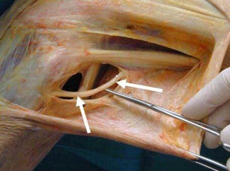 Az idegbecsípődés négy legfontosabb tünete