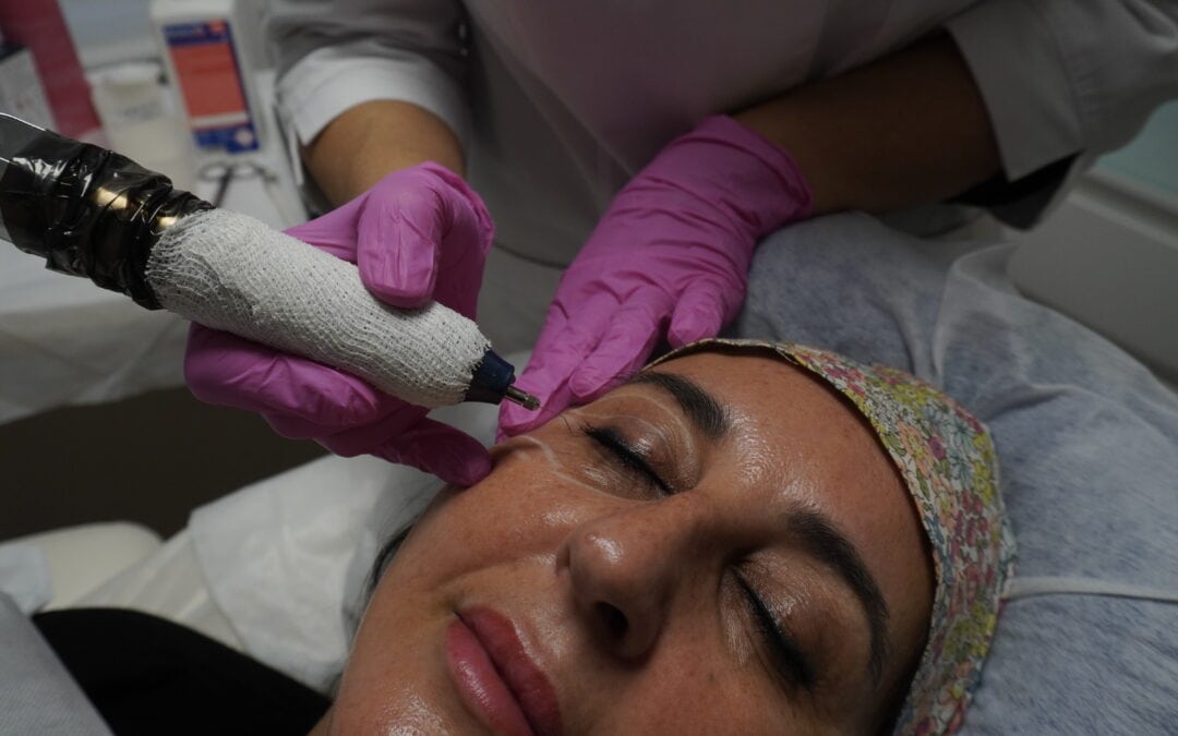 Plasma Pen: Rejuvenece antes del buen tiempo