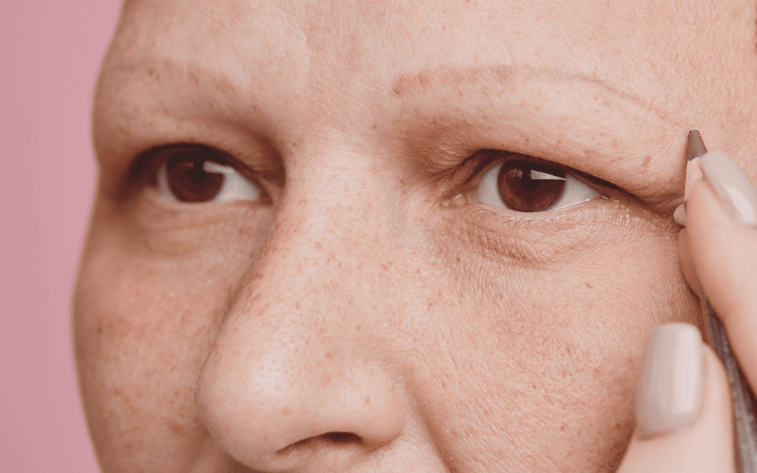 alopecia total en cejas
