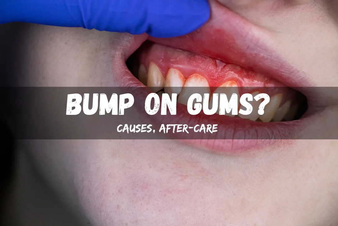 bump on gums