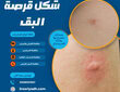 قرصة البق