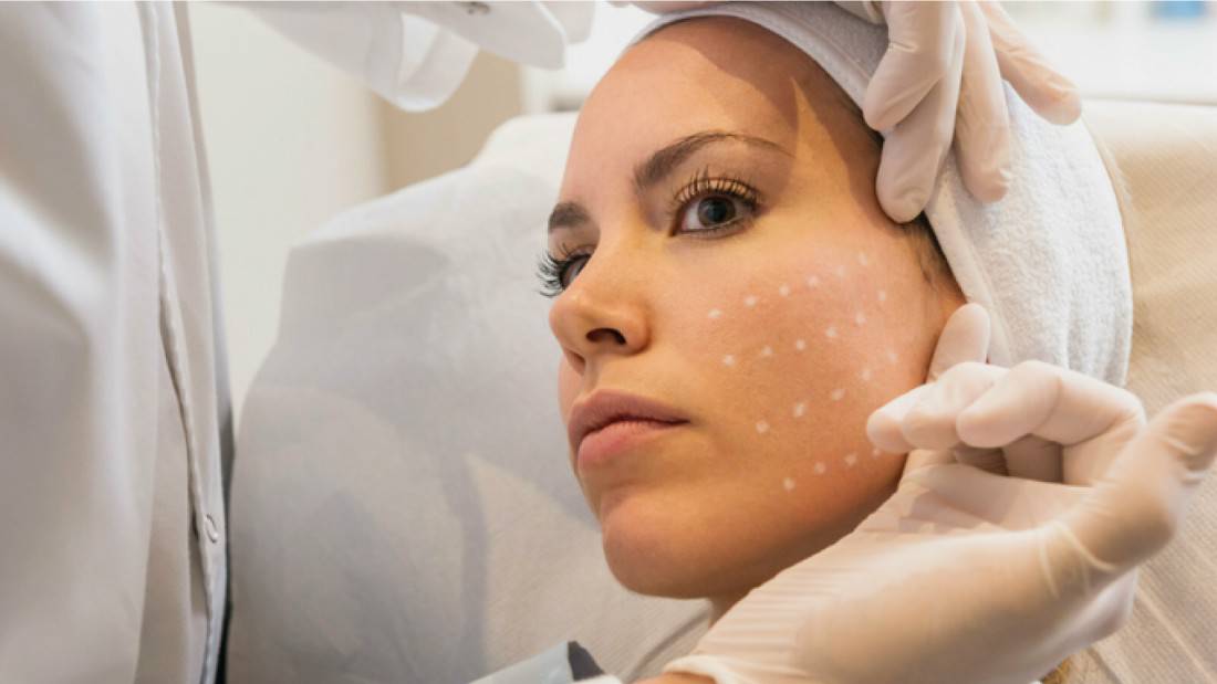 mesoterapia-facial-vitali-beauty