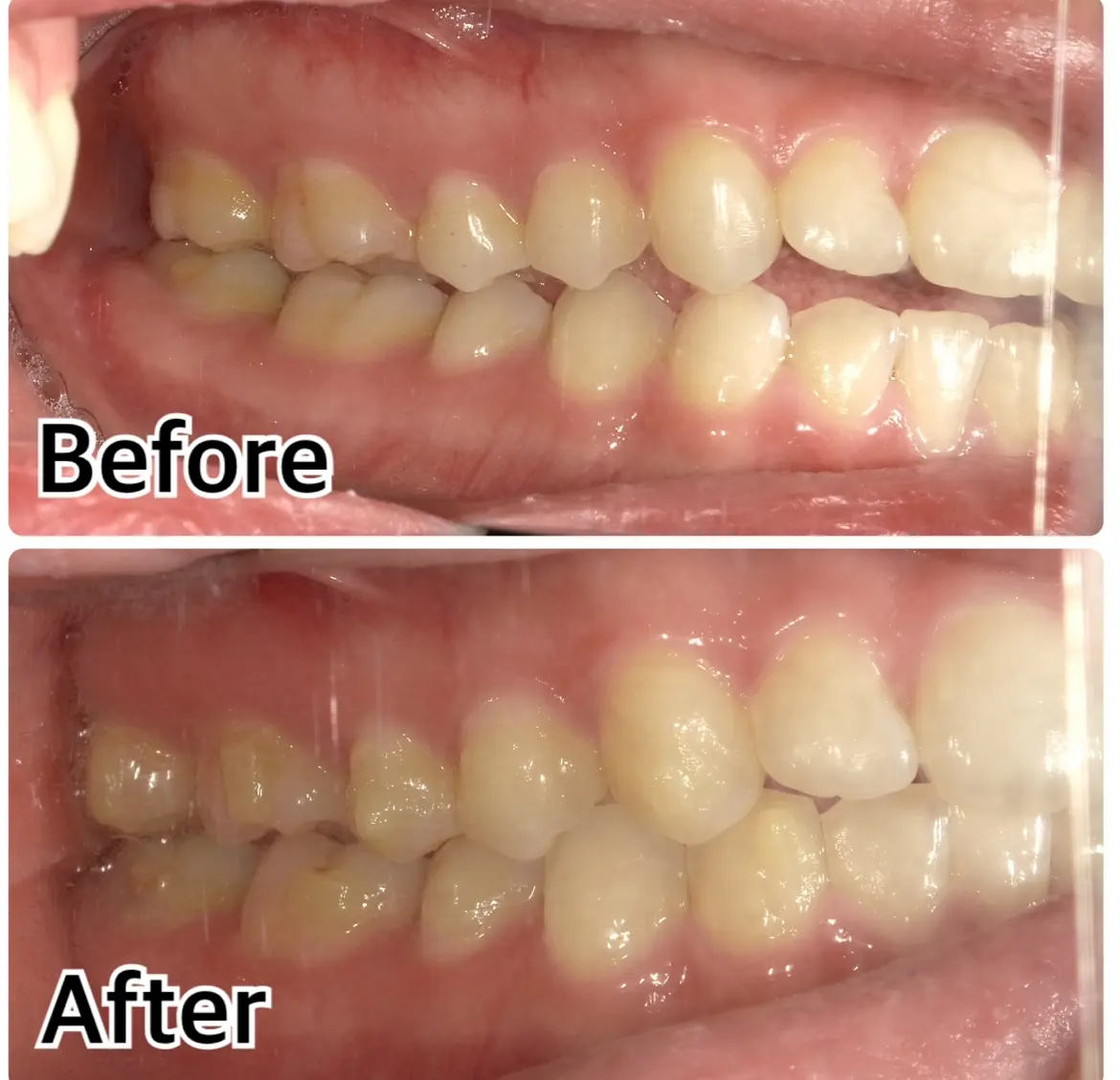 矯正始めて１年が経過しました