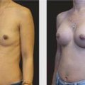 A Before and After photo of a Breast Augmentation Plastic Surgery by Dr. Craig Jonov in Seattle and Tacoma