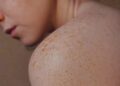 Des kinés formés pour détecter les cancers de la peau
