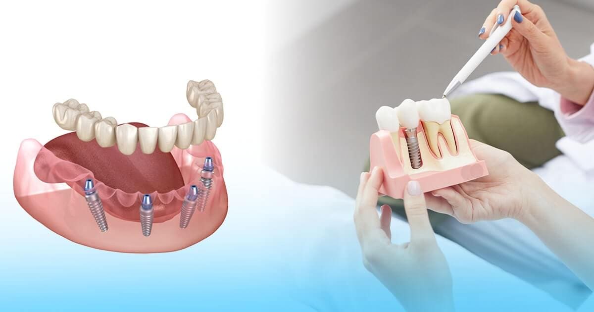 blog implant 4 on 1