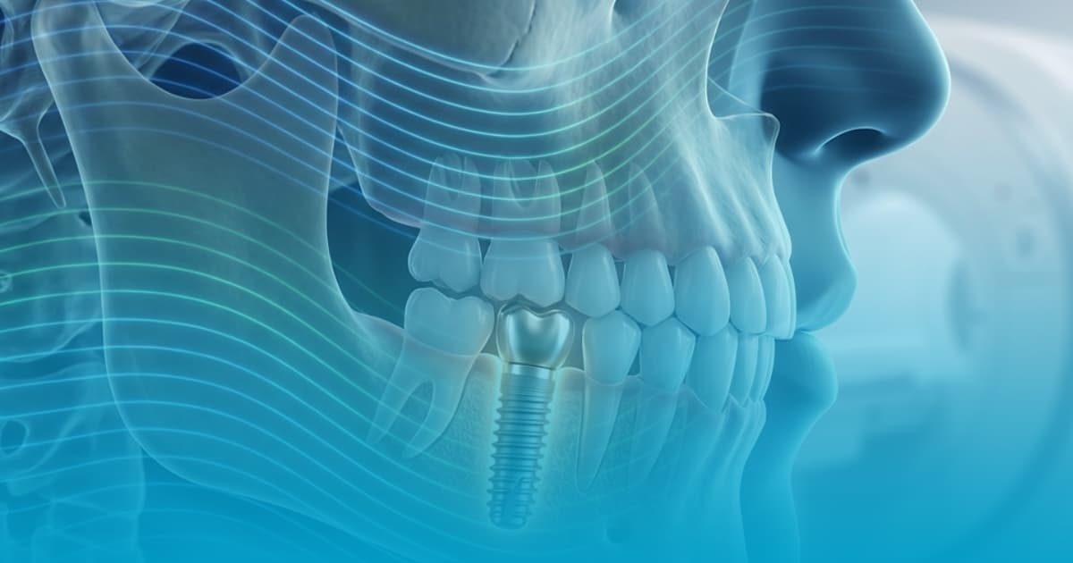Implant Dentar RMN