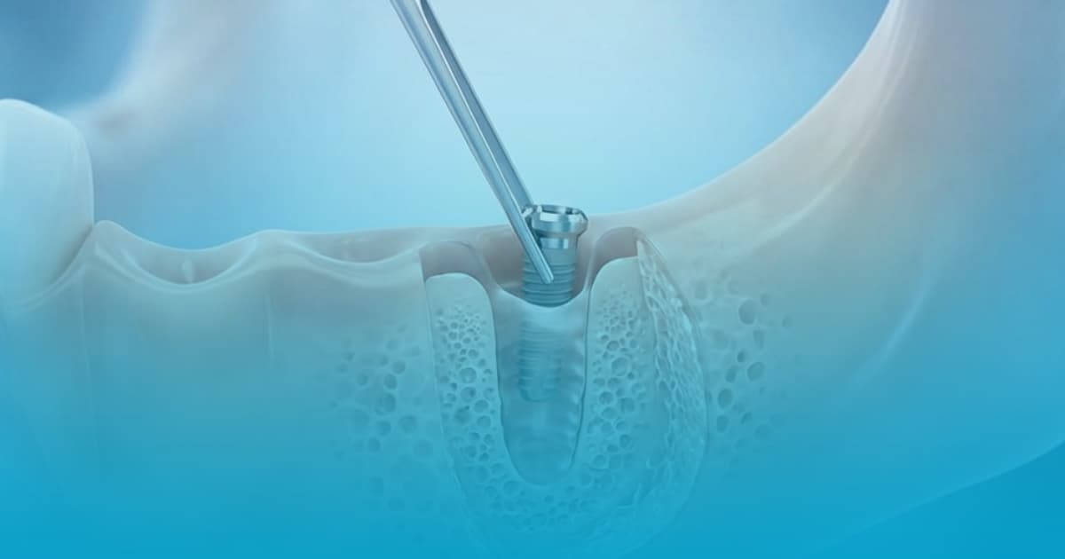 Scotere implant dentar