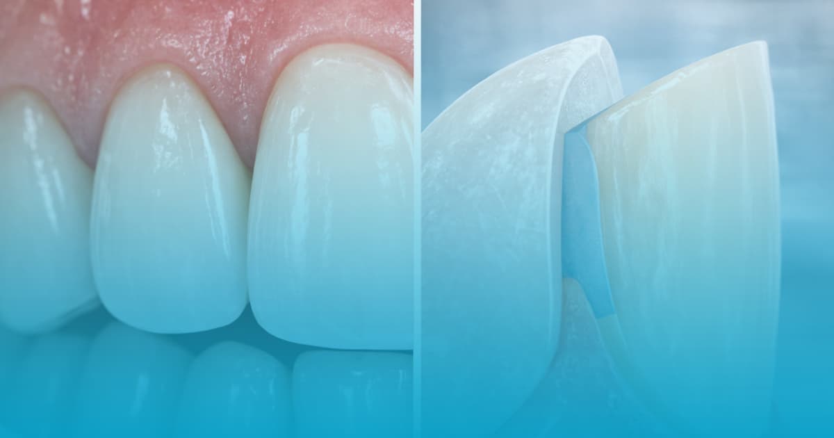 dezavantaje fatete dentare