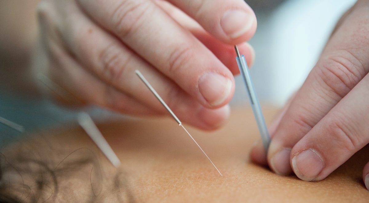 Get Relief from Health Issues with Acupuncture