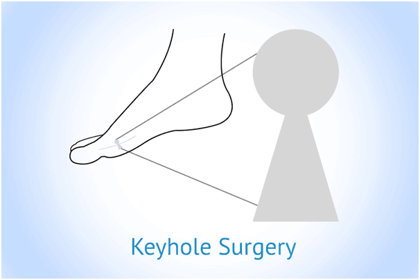 Minimally Invasive Foot and Ankle Surgery (Keyhole Surgery)