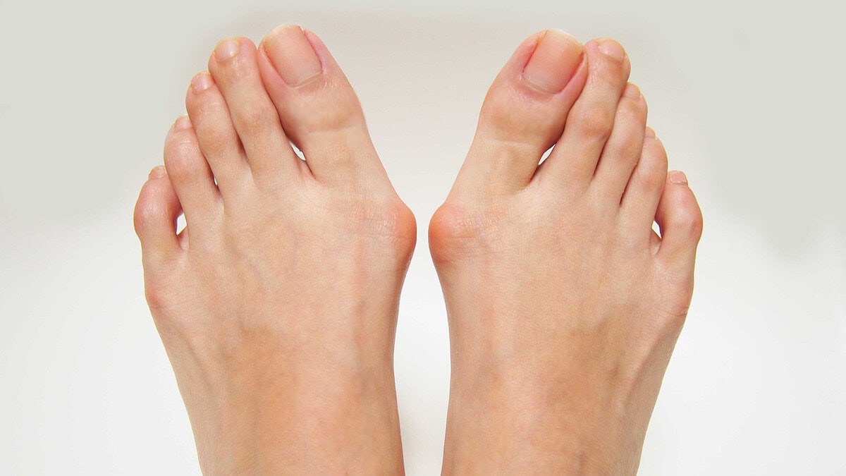 Bunion Laser Surgery