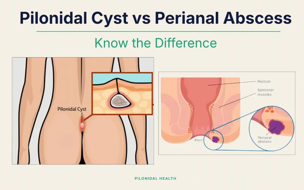 Pilonidal Cyst vs Perianal Abscess what is the difference Anatomical diagram showing the difference in location between a perianal abscess vs pilonidal cyst