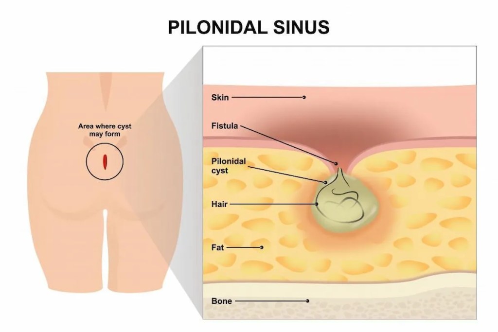 A pilonidal cyst develops in the natal cleft, between your buttocks