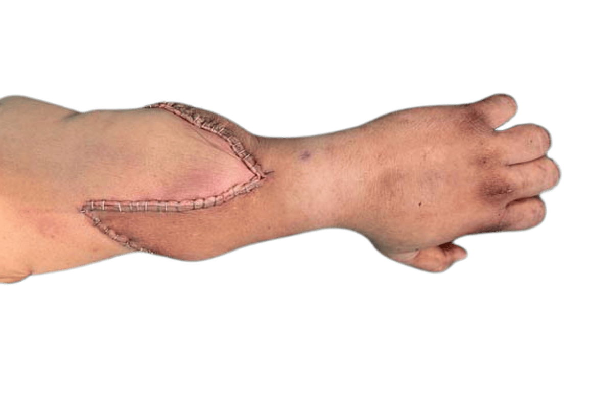 Hand Transplant